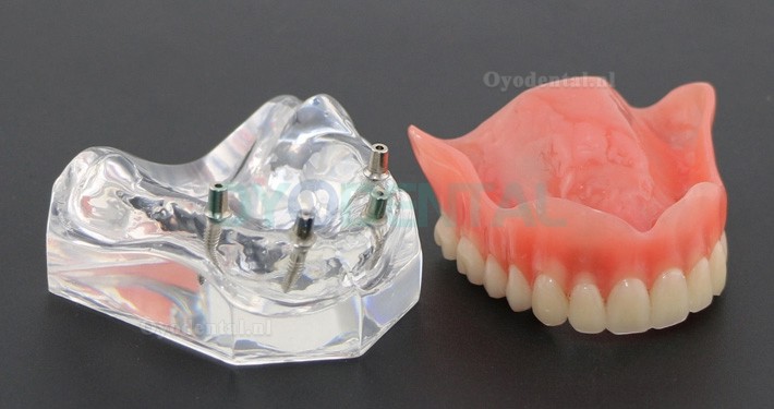 Tandheelkundige studie Tanden Model Overdenture met 4 implantaten Demo Model 6001